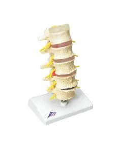 3B Scientific Degenerative Spine Anatomical Models